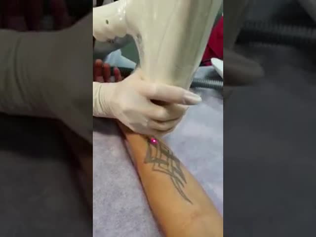 Портативная машина удаления татуировки лазера Яблока для НД Яг Лсер переключателя людей к видео