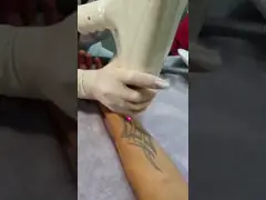 Портативная машина удаления татуировки лазера Яблока для НД Яг Лсер переключателя людей к video