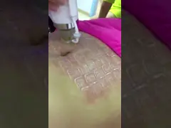 Коммерчески машина Rf Microneedle Rf красоты подмолаживания кожи video