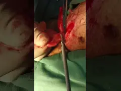 Medical Instrument Pets Surgery Ultrasonic Scalpel Class II Veterinary Ultrasonic Scalpel