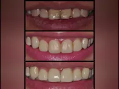 Система моста 3D цифров OEM PFM зубоврачебная Intraoral просматривая отображая video