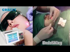 Не-хирургический самый лучший лазер обработки лицевой Endolifting1470nm Endolift стороны и стороны лазера подтяжки лица тела поднимаясь video