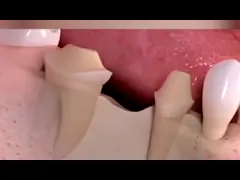 Лаборатория естественного принтера кроны 3D выглядеть резинового PFM зубоврачебного зубоврачебная video