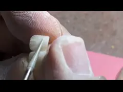 Крона неразводного моста подходящего как следует зубоврачебного моста кроны одиночная законченная video