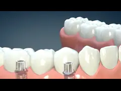 Custom Made Dental Lab Products Polymer Removable Partial Dentures