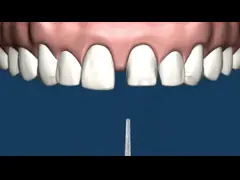 Co-CR MK1 Präzisions-Zubehör-Gebiss-Korrosionsbeständigkeit