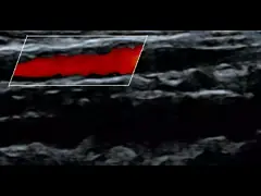 Зонд элемента блока развертки 128 ультразвука PICC 12MHz ручной Wifi video