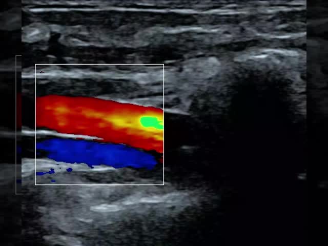 10MHz Portable Wireless Android Ultrasound Scanner With Type-C Connection