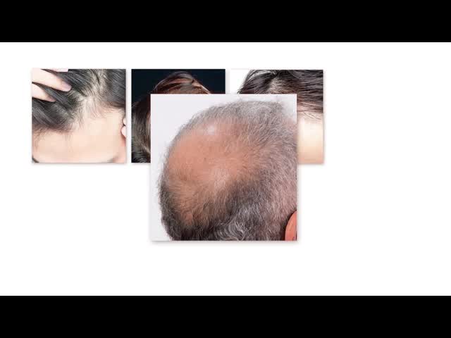 Растительный эффективный спрей для волос, масло для роста волос Противоустойчивое лечение волос видео