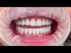 Laminate Laboratory Laminate High Translucency Dental Veneers cho tự nhiên và bóng