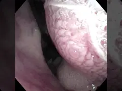 ZebraScope  4.8mm retroflxed rhinoscope
