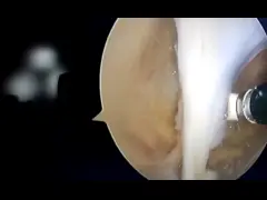 Система плазменной хирургии с точной коблацией для минимально инвазивных ортопедических операций video