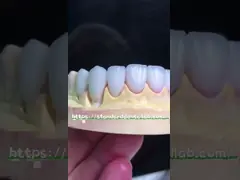Естественный вид Emax Veneers Crown Biocompatibility Bleaching Shade с минимальной подготовкой video