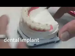 Функциональные эстетические зубные имплантаты кроновый мост video