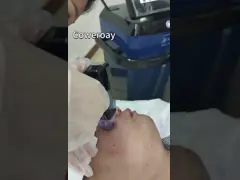 Morpheus 8 Skin Tightening Microneedle Fractional RF Machine 300W