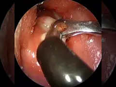 Minimally Invasive Ablation With ENT Plasma Scalpel State Of The Art Technology