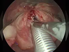 Ears Nose And Throat Plasma Wand With Advanced Three Stage ENT Probe