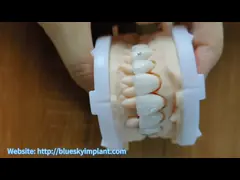 Highly Translucent Zirconia Crowns Bridge Veneers With Customized Jewelry And Gold Beautiful Dental Restoration Case