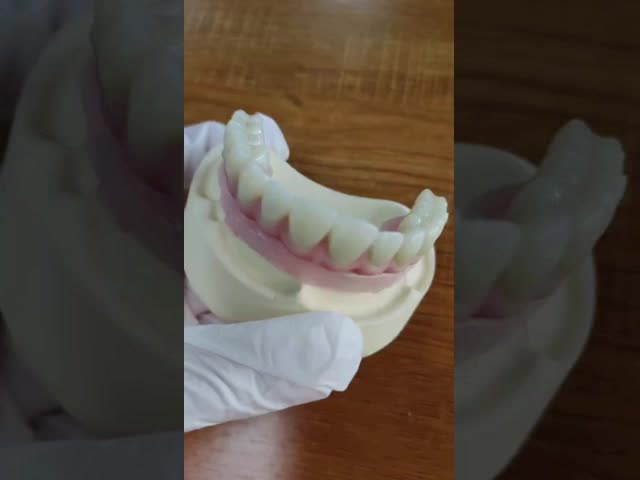 Screw retained MUA abutment Implant Cases Zirconia crowns Multilayer pink porcelain with Easy repair