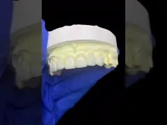 IPS EMAX Porcelain Veneers for Natural Looking Front Teeth Restorations