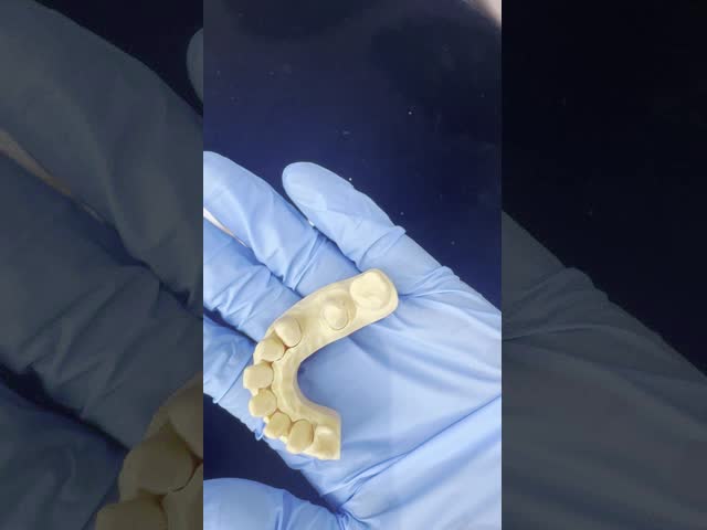 Full Contour Zirconia Crown Quick Turnaround for Precise and Aesthetic Fit in 1 Week