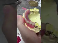 Easy Fit Cast Partial Denture Restores Chewing And Speaking Ability