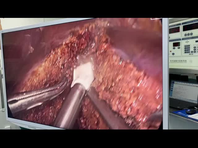 All In One Coblation Plasma Surgical Unit  With Multi Function Probe Energy Platform Hepatobiliary surgery
