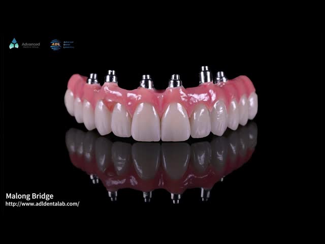 Implante de porcelana rosa híbrido Coroa Malong Ponte de implante de arco completo Carregamento imediato