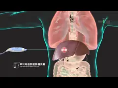 Precise Radio Frequency Surgery Electrode for Hepatectomy Ablation