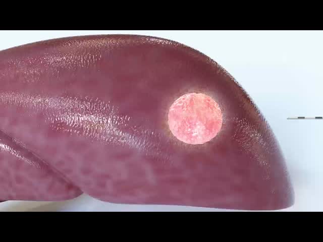 子宮筋腫 肝臓腫瘍 肺腫瘍 摘出