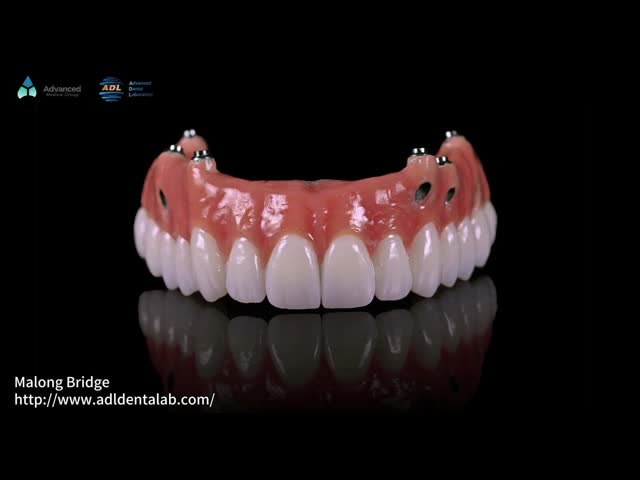 Coroa de porcelana rosa composta A1 Sombra All On 4 parafuso de titânio híbrido retido