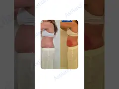 Effective Cryolipolysis Slimming Machine for Targeted Fat Loss and Cellulite Reduction