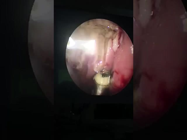 バターフライ 軟骨 と 腺体 の ENT 手術 器具