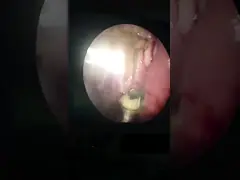 ButterFly ENT Surgery Instruments For Tonsil & Adenoid