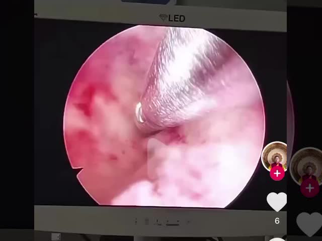 ENT Gynecological Tissue Morcellation Plasma Surgical System with 7-Inch Touch Screen