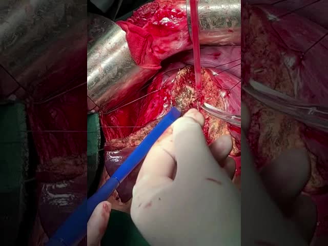 Bipolar Sealers for Orthopaedics, Spine,Oncology, Neurosurgery, Thoracic, and Cardiac Implantable Electronic Devices