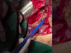 China Single Loop Design BPH Surgery Plasma Probe Unmatched Performance for Resection supplier