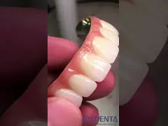 Restoring Chewing Function Ti-Bar Zirconia Hybrid Bridge With High Biocompatibility And Precise Fit