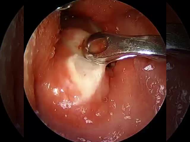 Micro Invasive ENT Probe For Vocal Cord Surgery 0.5mm Precision