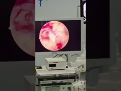 China Single Loop Design BPH Surgery Plasma Probe Unmatched Performance for Resection supplier