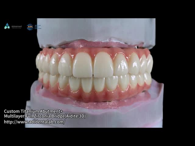 Translucent Full Contour Zirconia Bridge Over Milled Implant Bar Customized Design
