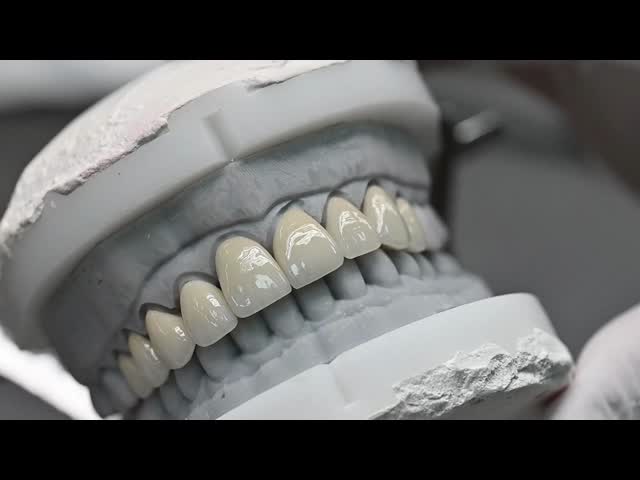 China Dental Lab High Esthetics Translucency EMAX Veneer with 0.3-0.5mm Thickness for Anterior and Posterior Restorations