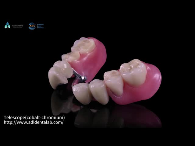 Telescope Inner Co-Cr And Outer Co-Cr Metal Partial With Composite