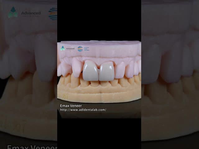 Natural Pressed EMAX Veneer Strength 16 Shades Emax Teeth Veneers