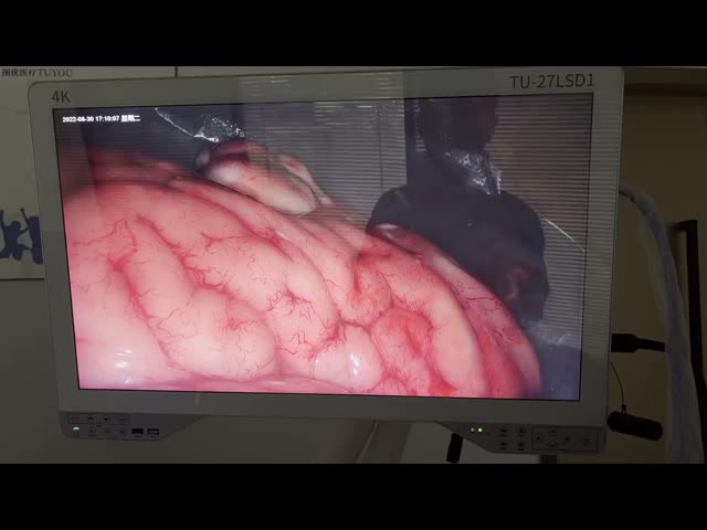 TUYOU 27LSD1A 4K 27 Inch Endoscope Camera with 8 Hours Battery Life IPX8 Waterproof and 2 Years Warranty for ENT Laparoscopy Hysteroscopy Urology