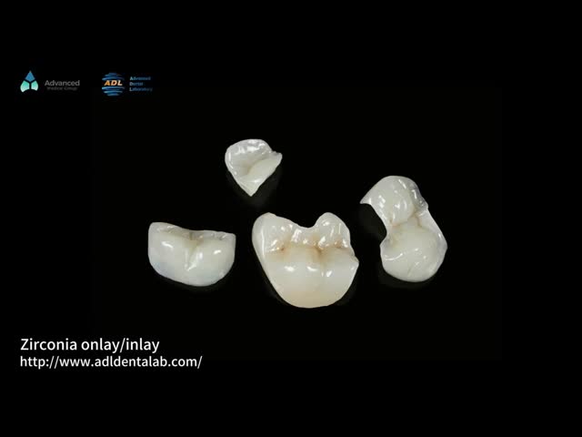 Translucent Onlay Zirconia Inlay For Long Lasting Stain And Wear Resistance