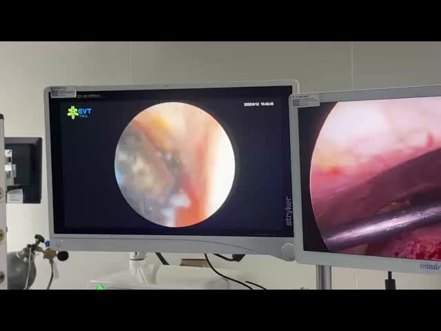 EVT Medical Multi Directional Stone Retrieval Basket Complex Anatomies Ureteral Stone Basket