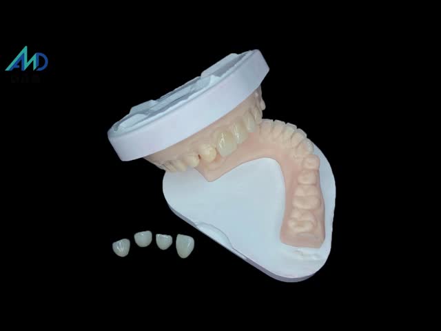 IPS Emax Veneers Minimal Prep/ No-prep Veneers Are Innovative Solutions For Beautiful Smile