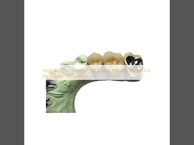 High Biocompatibility PFM Crown Porcelain Fused For Back Teeth Restoration