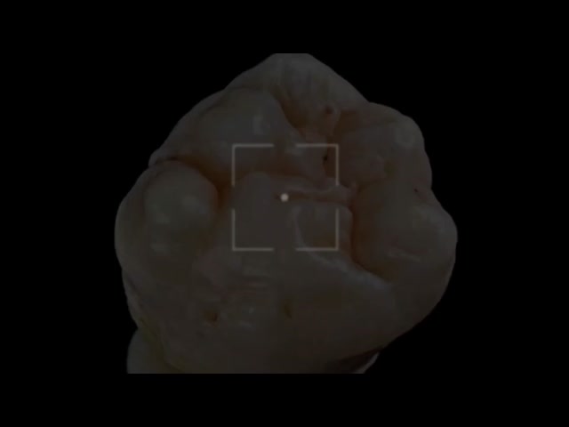 Full Zirconia Ceramic Dentures High Precision Digital Production For Functional Restoration